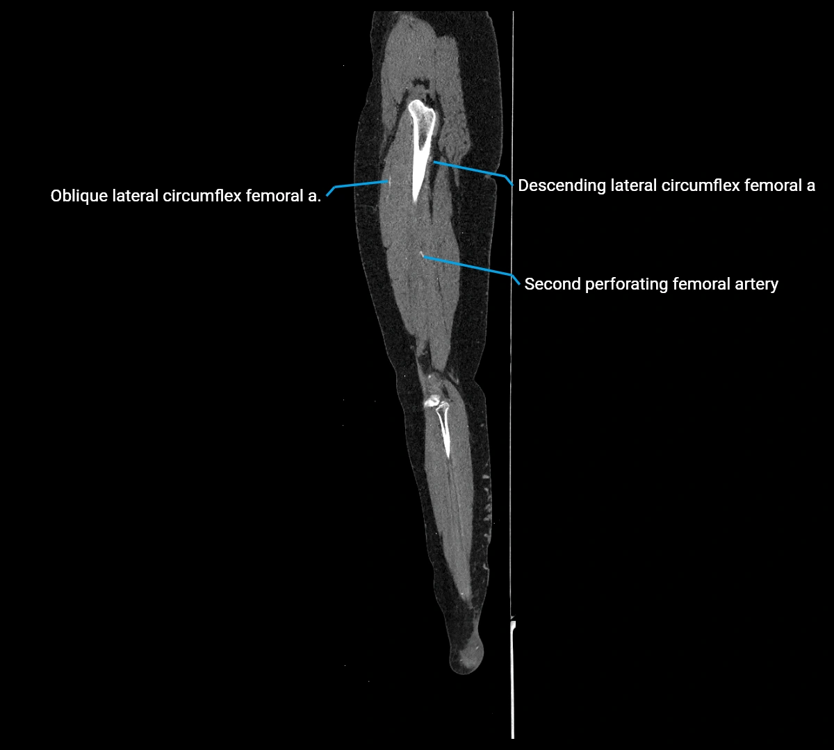 CTA lower limb sagittal cross sectional anatomy labelled image _59 (3).webp